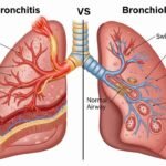 bronchitis vs bronchiolitis