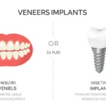veneers or implants